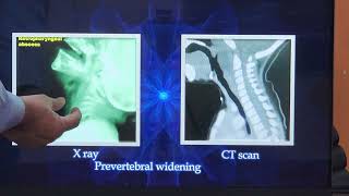 Acute Retropharyngeal Abscess  Tamil  Patient teaching programme [upl. by Andi484]