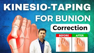 GREAT TOE CORRECTION BY RIGID  KINESIOTAPING IN BUNION  LEARN THE METHOD FOR BEST RESULTS [upl. by Alston515]