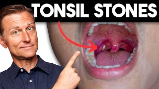 Tonsil Stones Removing the Deeper Cause [upl. by Livvy]