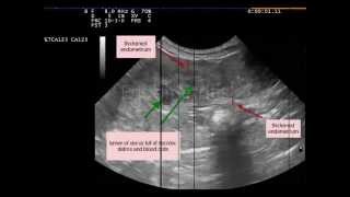 Endometritis not pyometra dog [upl. by Rehotsirhc]