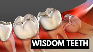 Wisdom teeth Causes Symptoms and Treatment [upl. by Atinahc608]