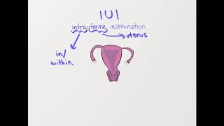 What is IUI Intrauterine Insemination [upl. by Eldnek]