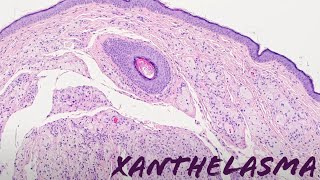 Xanthelasma xanthoma of eyelid yellow bumps around eye pathology dermpath dermatology [upl. by Albemarle174]