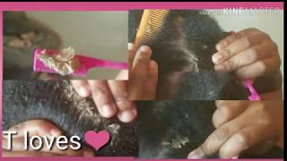 Part 4 SCALP SCRATCHING PSORIASIS FLAKES [upl. by Diamond155]