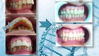 العلاج التقويمي للبروز الشديد في الأسنان العلوية Orthodontic treatment of severe protrusion [upl. by Ahterahs]