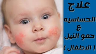 علاج الحساسيه فى الاطفال  علاج حمو النيل  allergy  كورس التدريب الصيدلى [upl. by Gran]