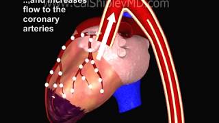 Cardiogenic Shock and Intraaortic Balloon Pump by Dr Cal Shipley MD [upl. by Htebaras839]