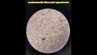 Hematologyanaemiamicrocytic hypochromicpathologymedical [upl. by Munn]