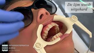 Plaatsen Invisalign beugel Orthodontiepraktijk Almelo [upl. by Kwapong757]