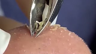 Deep Dive Blackhead Removal The Tweezer Method [upl. by Ahsital]