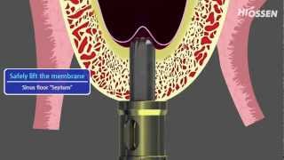 OSSTEM  HIOSSEN CASKit Crestal Approach Sinus Kit [upl. by Leuneb228]