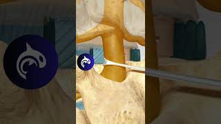 See what a Posterior Lumbar Interbody Fusion of the Spine looks like in 3D Animation [upl. by Ilaw]