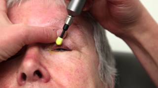 Blepharitis Treatment That Really Works Blephex Eyelid Cleaning [upl. by Laktasic56]