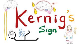 Kernig Sign  Meningitis  Neurology Physical Exam [upl. by Felita658]