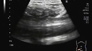 Ultrasound Video showing acute appendicitis [upl. by Monti635]