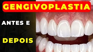 Gengivoplastia antes e depois [upl. by Essa]