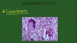 Inflamação Crônica  Resumo  Patologia Geral [upl. by Lipp]