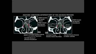 Uncinate process [upl. by Phene]