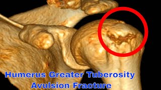 Humerus Greater Tuberosity Avulsion Fracture The Most Painful Fracture Youll Ever Experience [upl. by Mavilia]