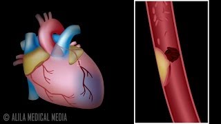 Myocardial Infarction and Coronary Angioplasty Treatment Animation [upl. by Broadbent]