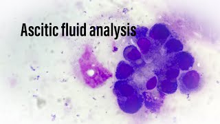 Ascitic fluid analysis  biochemical and cytological evaluation [upl. by Ashly366]