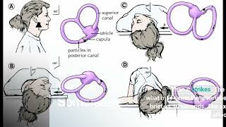 Our Home Epley Maneuver Johns Hopkins Medicine Statements [upl. by Caddaric]