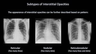 How to Interpret a Chest XRay Lesson 7  Diffuse Lung Processes [upl. by Caressa727]