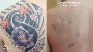 Laser Tattoo Removal  Before and Afters Gallery [upl. by Lerner820]