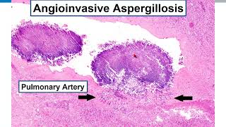 Lung Histopathologic Review Preparation for Boards Exams AND for Daily Practice [upl. by Jozef267]