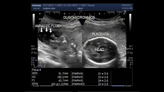 Oligohydramnios with loss of fetal movements and Pregnancy of about 23 weeks [upl. by Socin]