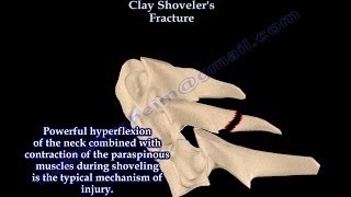 Clay Shovelers Fracture of the cervical spine  Everything You Need To Know  Dr Nabil Ebraheim [upl. by Teriann]