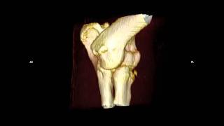 3D elbow dog ct corronoideal process wwwctinvetcom [upl. by Alleen504]