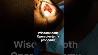 Wisdom tooth treatment  Operculectomy  Wisdom teeth surgery Wisdom tooth removal proceduredental [upl. by Thea]