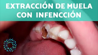 ¿Se puede sacar una MUELA con INFECCIÓN 😣  Respuesta médica [upl. by Rebba]