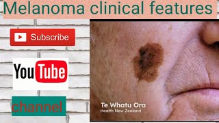 Melanoma features investigation and management [upl. by Crotty40]