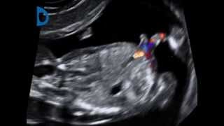 Fetal Medicine Foundation  umbilical cord duplication at 12 weeks [upl. by Mat]