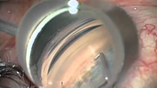 Combined Cataract Procedure with iStent Glaucoma Implant [upl. by Enyal]