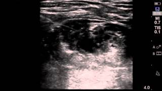 Ultrasound guided interscalene brachial plexus block [upl. by Lednem267]