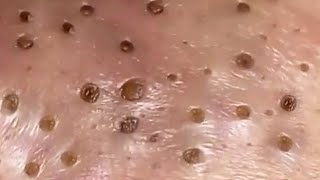 Blackheads amp Whiteheads Satisfying Removal 0133 [upl. by Kcaz737]