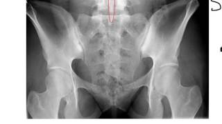 Sacrum Coccyx and SI Joints [upl. by Sharos217]