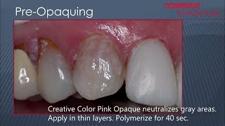 Composite Veneers  Layer that counts [upl. by Akire]