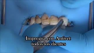 Antivet sin Microabrasión [upl. by Adnilre381]