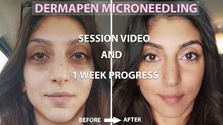 Dermapen Microneedling Before And After  Process  1 Week Amazing Results [upl. by Eded]