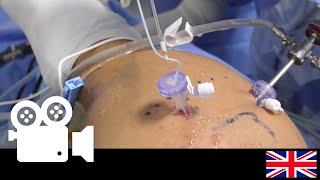 New Surgical Video Complete Tear of the Supraspinatus Tendon  Arthroscopic Repair [upl. by Munafo183]