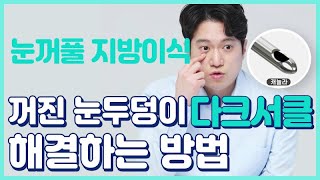 눈밑 다크서클이 심하다면 눈두덩이 꺼짐이 심해졌다면 나노지방이식 1편 테일러성형외과 [upl. by Noinatrad]