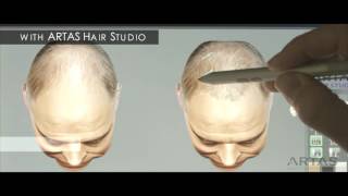 Hair Restoration on Long Island  ARTAS Procedure [upl. by Leina35]