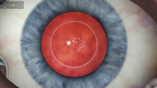 Introducing the ORA system with VerifEye technology for Premium Cataract Surgery [upl. by Normak969]