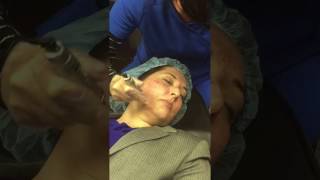 MesoPen MicroNeedling Treatment [upl. by Gerson691]