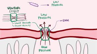 Endocarditis infective libman sacks causes symptoms treatment amp pathology [upl. by Trixie]