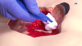 How to Effectively Cleanse and Debride a Wound  Wound Cleansing and Debridement  Ausmed Education [upl. by Largent]